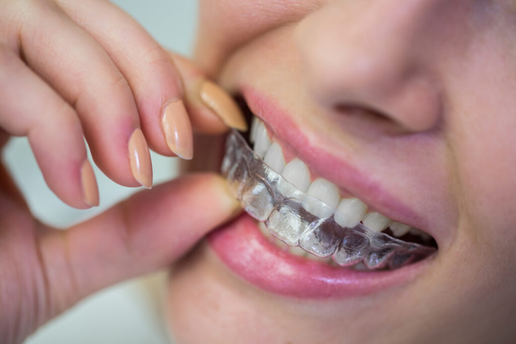 braces-and-aligners