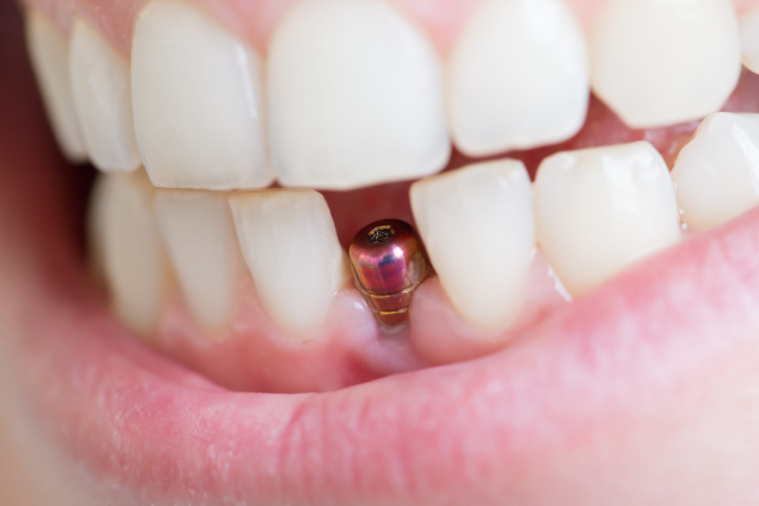 Dental-Implant