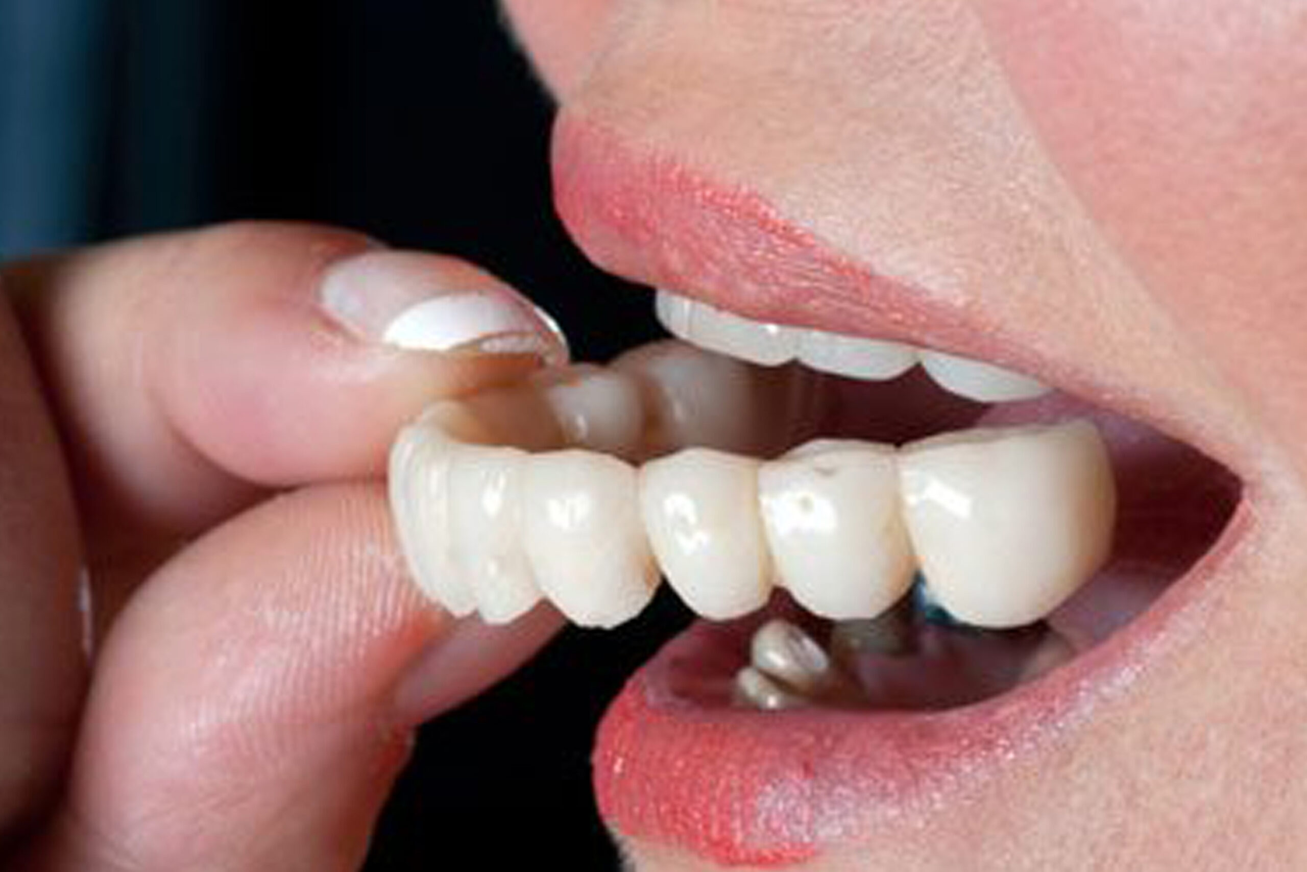 dental-crowns-and-bridges-decode