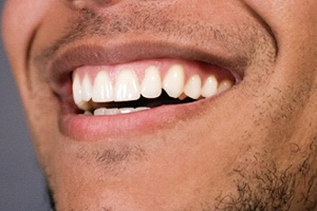 smile-makeover-decode-dental