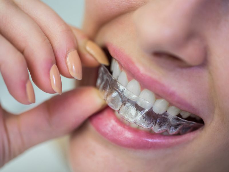 braces-and-aligners