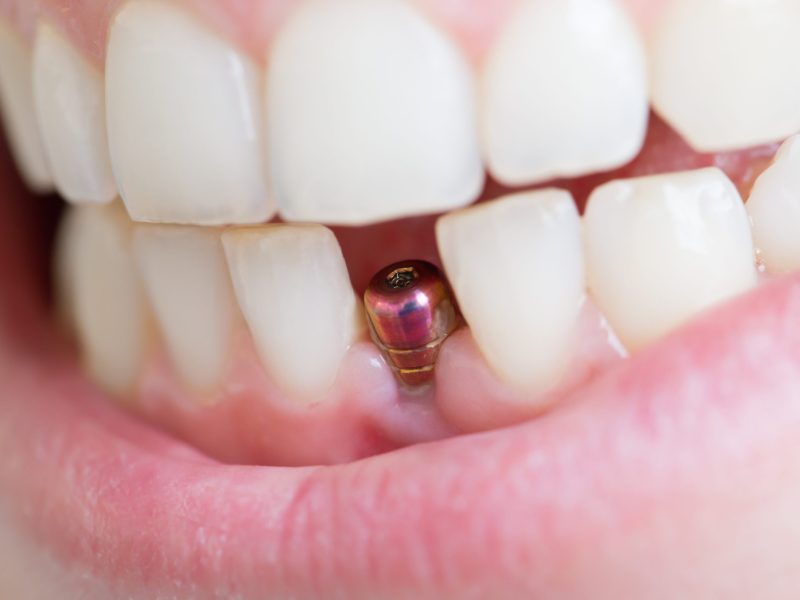 Dental-Implant