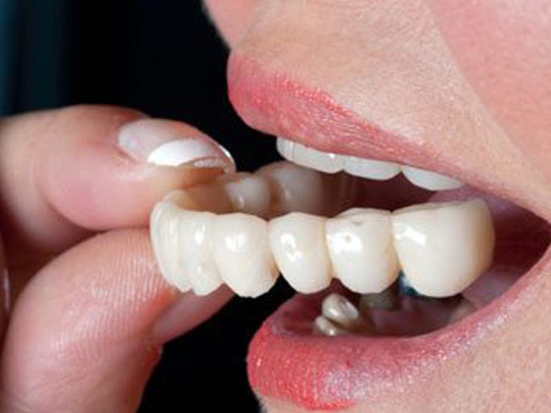 dental-crowns-and-bridges-decode